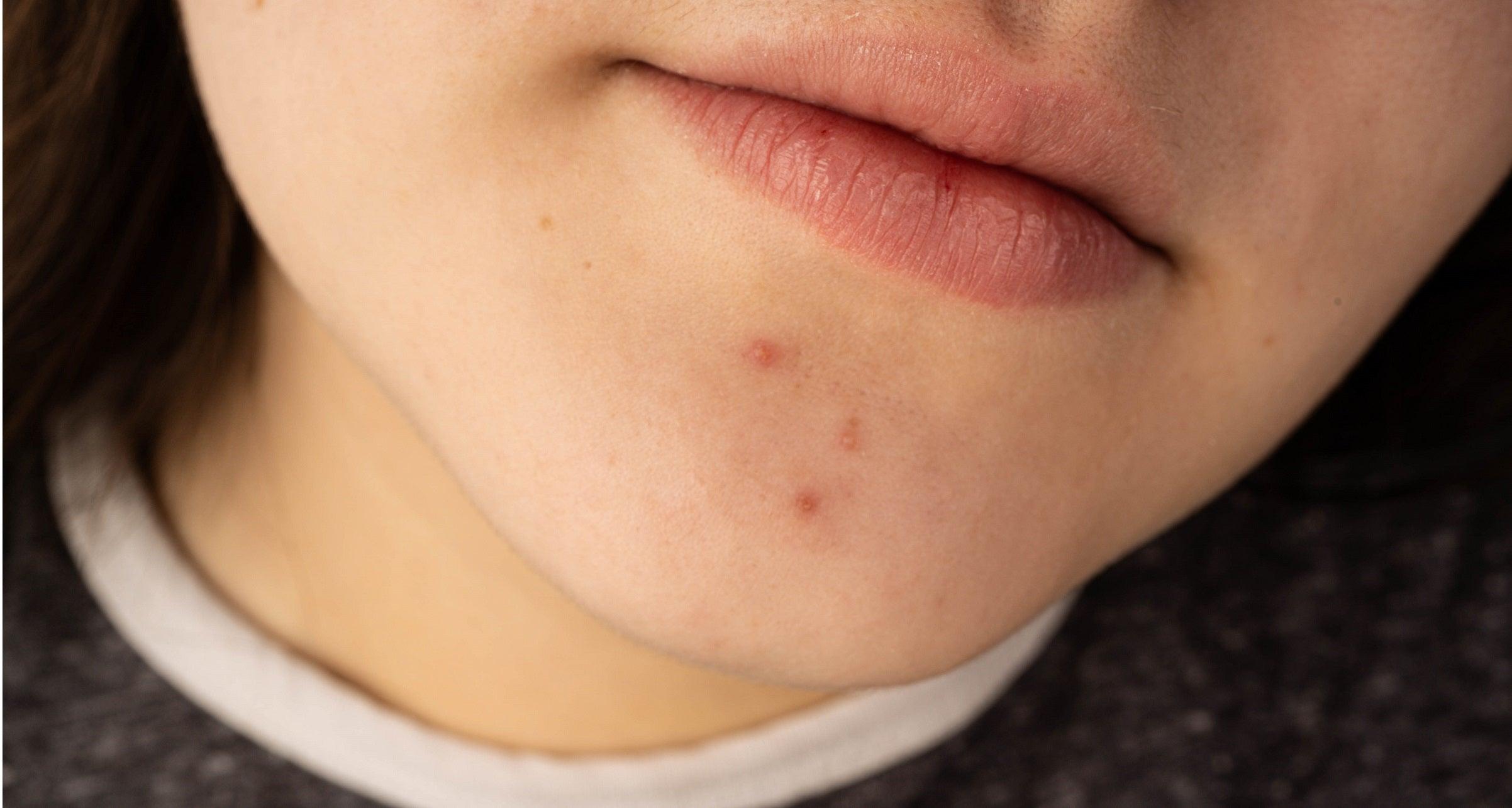 Cómo prevenir y mejorar las marcas y cicatrices del acné - Chok Chok Beauty