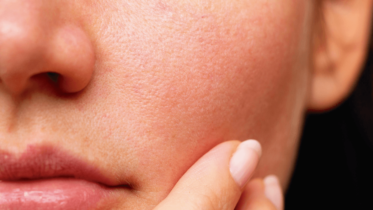 Evita y Trata la Textura en la Piel - Chok Chok Beauty