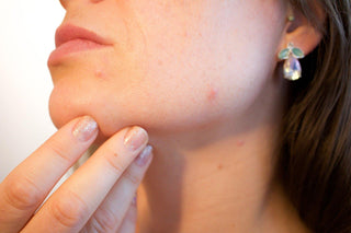 Cómo solucionar la piel grasa con acné - Chok Chok Beauty