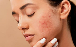 ¿Cómo tratar la piel sensible e irritable? - Chok Chok Beauty